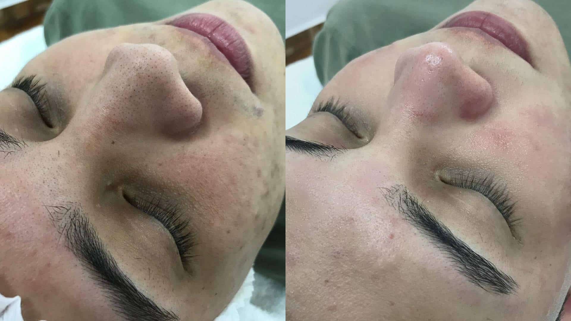 Resultado de antes e depois da limpeza de pele. Close do nariz de uma cliente mostrando a pele com cravos e, ao lado, a pele limpa e lisa após o procedimento.